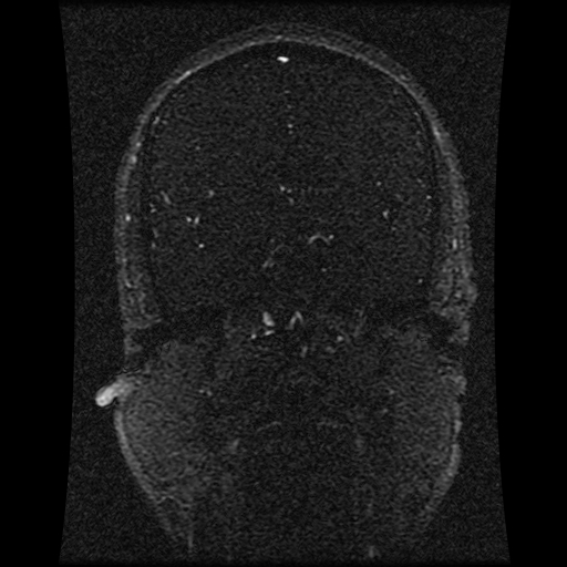 Carotid arterial dissection with acute cerebral infarction (Radiopaedia 26636-26784 MRV 98).jpg