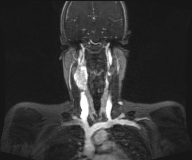 Carotid body tumor (Radiopaedia 12777-12912 MRA 33).jpg