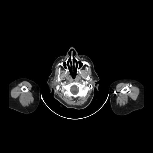 File:Carotid body tumor (Radiopaedia 21021-20948 B 5).jpg