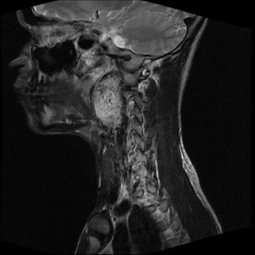 File:Carotid body tumor (Radiopaedia 30208-30823 Sagittal T2 13).jpg