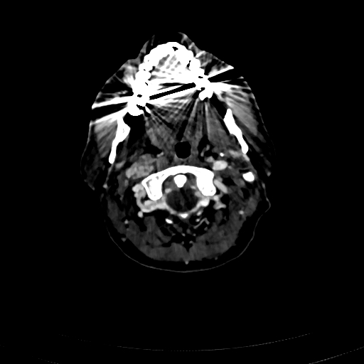 Carotid body tumor (Radiopaedia 83615-98727 D 37).jpg