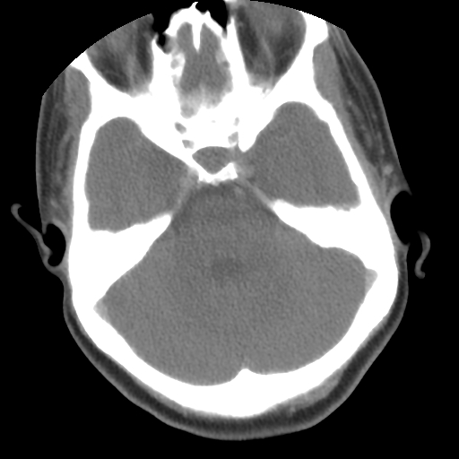 File:Carotid body tumor (paraganglioma) (Radiopaedia 38586-40729 A 37).jpg