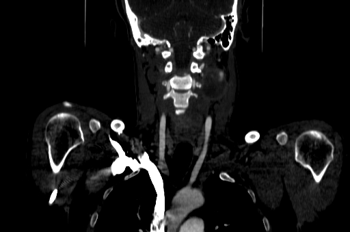 File:Carotid bulb pseudoaneurysm (Radiopaedia 57670-64616 D 42).jpg