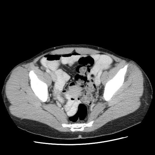 File:Castleman disease with fibrous pseudotumor in the abdomen (Radiopaedia 77296-89373 A 106).jpg