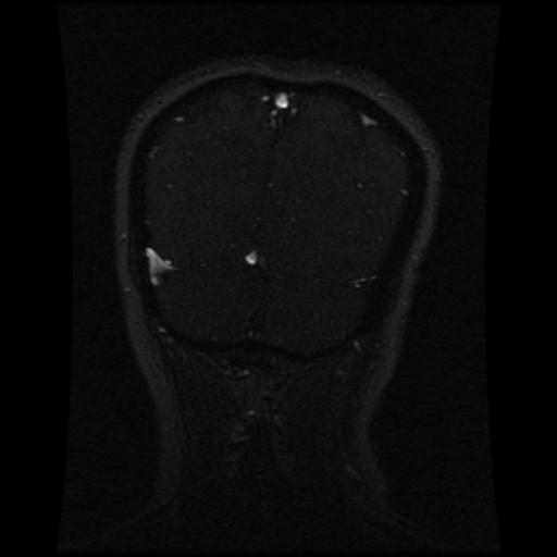 Cavernoma with developmental venous anomaly (Radiopaedia 22470-22507 MRV 37).jpg