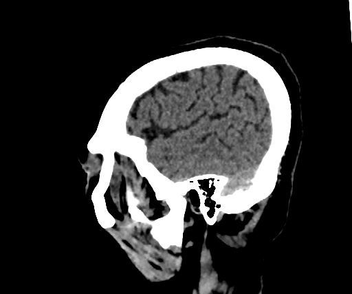 Cavernous hemangioma of the cerebellar falx (Radiopaedia 73025-83723 B 273).jpg