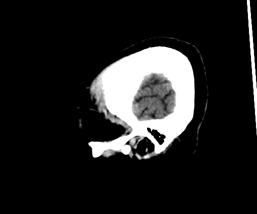 Cavernous hemangioma of the cerebellar falx (Radiopaedia 73025-83723 B 298).jpg