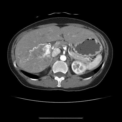 Cavernous hepatic hemangioma (Radiopaedia 75441-86667 A 35).jpg