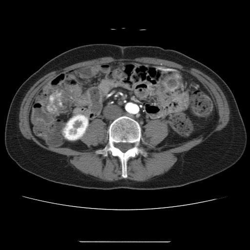 File:Cavernous hepatic hemangioma (Radiopaedia 75441-86667 A 66).jpg