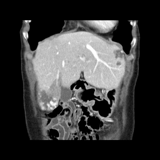 Cavernous hepatic hemangioma (Radiopaedia 75441-86667 C 34).jpg