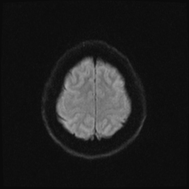 Cavernous sinus meningioma (Radiopaedia 63682-72367 DWI 39).jpg