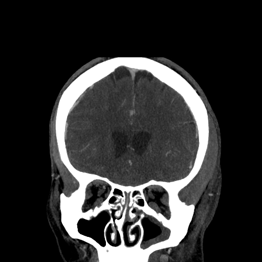File:Cavernous sinus thrombosis (Radiopaedia 10619-11078 D 6).jpg