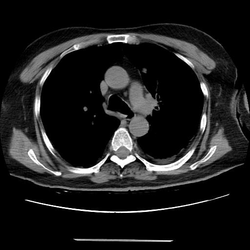 Cavitating pulmonary metastases (Radiopaedia 89545-106544 Axial non-contrast 22).jpg
