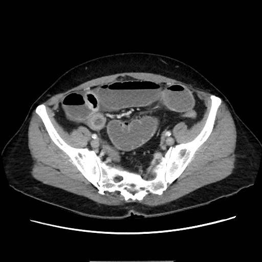 Cecal adenocarcinoma (Radiopaedia 75909-87331 A 70).jpg
