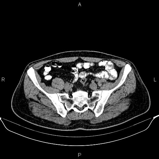 Cecal adenocarcinoma (Radiopaedia 85324-100916 Axial non-contrast 74).jpg