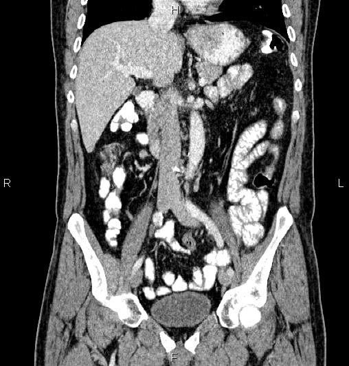 Cecal adenocarcinoma (Radiopaedia 85324-100916 D 30).jpg