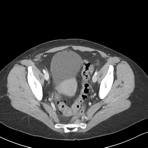 Cecal internal hernia through the foramen of Winslow (Radiopaedia 44820-48651 B 65).png