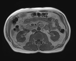File:Cecal mass causing appendicitis (Radiopaedia 59207-66532 Axial T1 in-phase 63).jpg