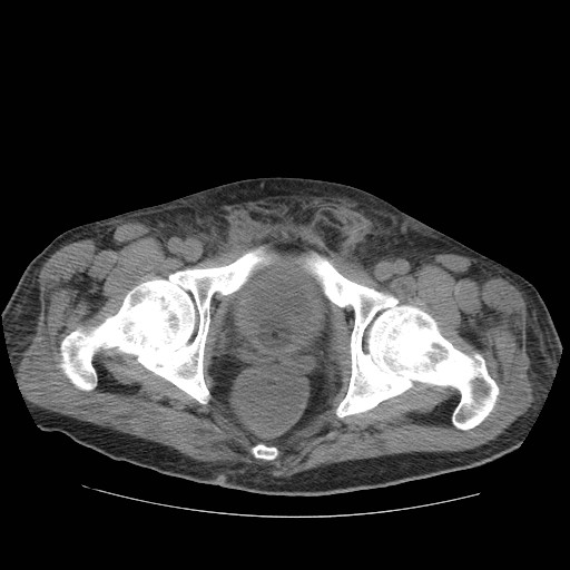 Cecal volvulus (Radiopaedia 28294-28534 Axial non-contrast 80).jpg