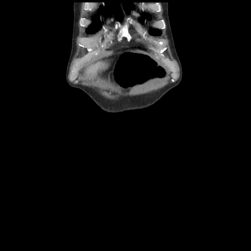 Cecal volvulus (Radiopaedia 89212-106088 D 4).jpg