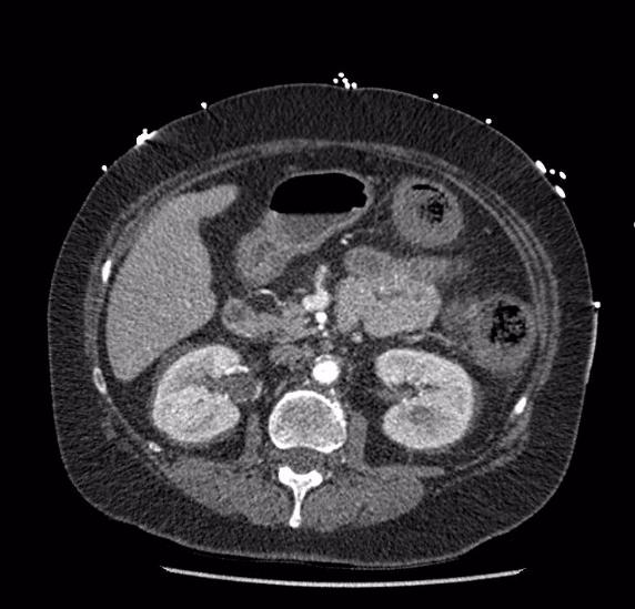 File:Celiac artery severe stenosis and dissection (Radiopaedia 44128-47842 B 37).jpg