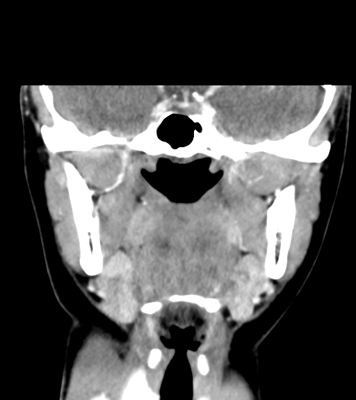 File:Cemento-ossifying fibroma (Radiopaedia 46243-50643 Coronal C+ delayed 33).png