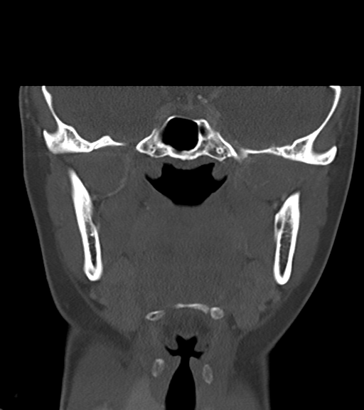 Cemento-ossifying fibroma (Radiopaedia 46243-50643 Coronal bone window 33).png