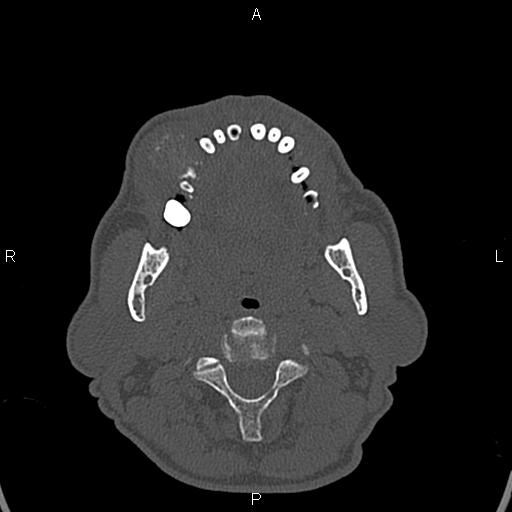 File:Central giant cell granuloma (Radiopaedia 83346-97761 Axial bone window 10).jpg