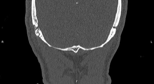 File:Central giant cell granuloma (Radiopaedia 83346-97761 Coronal bone window 48).jpg