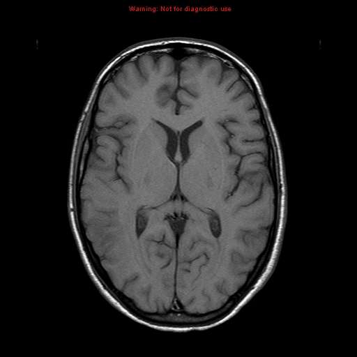 File:Central nervous system vasculitis (Radiopaedia 8410-9235 Axial T1 13).jpg