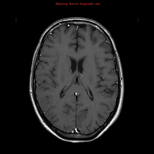 File:Central nervous system vasculitis (Radiopaedia 8410-9235 Axial T1 C+ 14).jpg