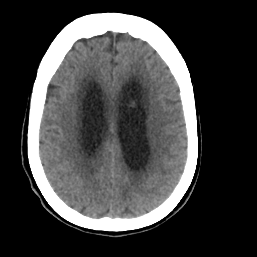 Central neurocytoma (Radiopaedia 65317-74346 Axial non-contrast 34).png