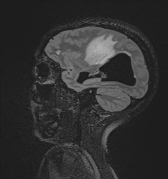 File:Central neurocytoma (Radiopaedia 84497-99872 Sagittal Flair + Gd 108).jpg
