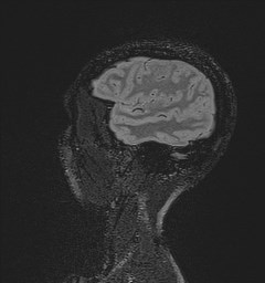Central neurocytoma (Radiopaedia 84497-99872 Sagittal Flair + Gd 33).jpg