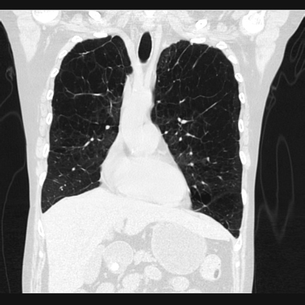 Centrilobular pulmonary emphysema (Radiopaedia 24495-24789 Coronal lung window 25).jpg