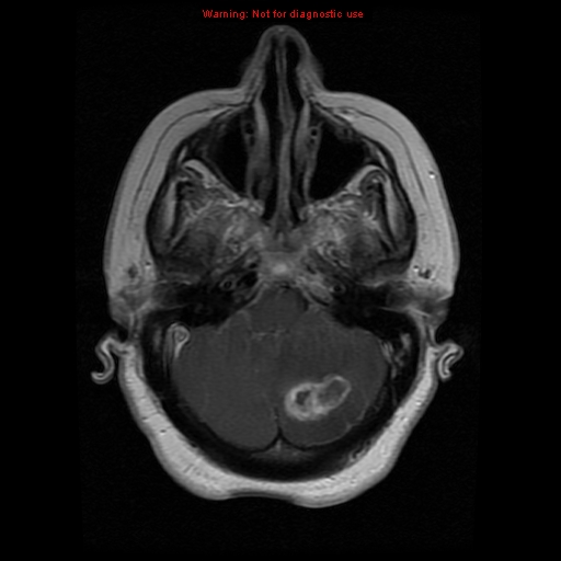 File:Cerebellar abscess (Radiopaedia 10845-11275 Axial T1 C+ 1).jpg