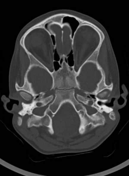 Cerebellar abscess (Radiopaedia 73727-84527 Axial bone window 22).jpg