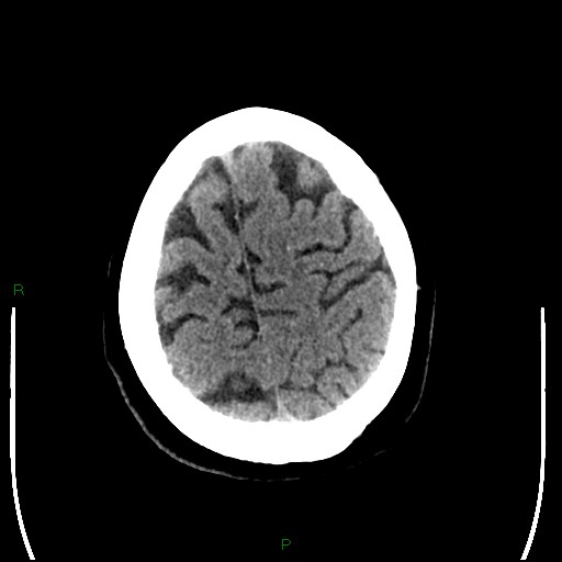 Cerebellar abscess (Radiopaedia 78135-90671 Axial non-contrast 92).jpg