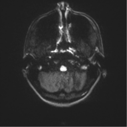 Cerebellar agenesis with hypoplastic pons (pontocerebellar hypoplasia) (Radiopaedia 57224-64138 Axial DWI 43).png