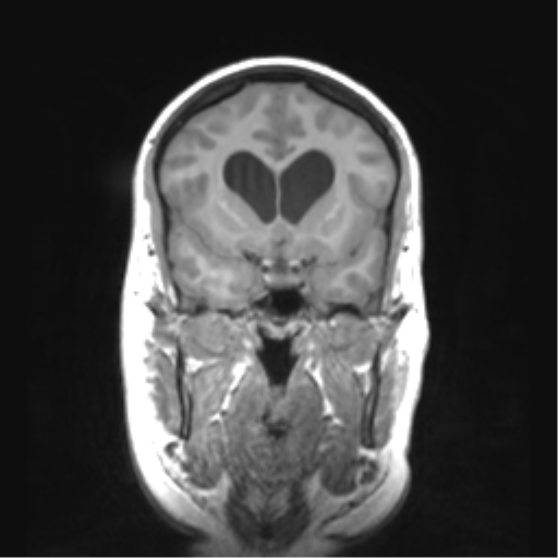 Cerebellar ependymoma complicated by post-operative subdural hematoma (Radiopaedia 83322-97736 Coronal T1 20).png