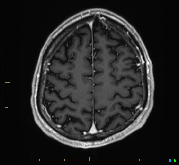 Cerebellar gangliocytoma (Radiopaedia 65377-74422 Axial T1 C+ 114).jpg