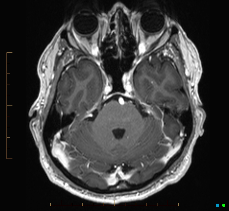 Cerebellar gangliocytoma (Radiopaedia 65377-74422 Axial T1 C+ 33).jpg