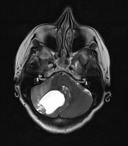 File:Cerebellar hemangioblastoma (Radiopaedia 18890).jpg
