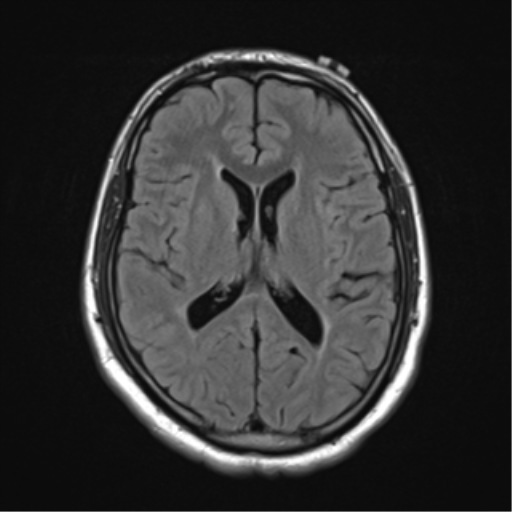 File:Cerebellar hemangioblastomas and pituitary adenoma (Radiopaedia 85490-101176 Axial FLAIR 17).png