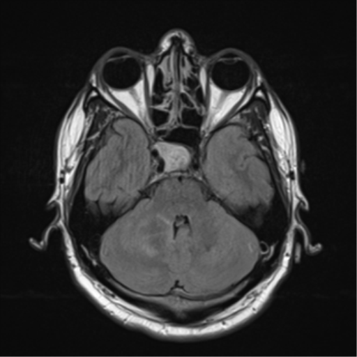 File:Cerebellar hemangioblastomas and pituitary adenoma (Radiopaedia 85490-101176 Axial FLAIR 9).png