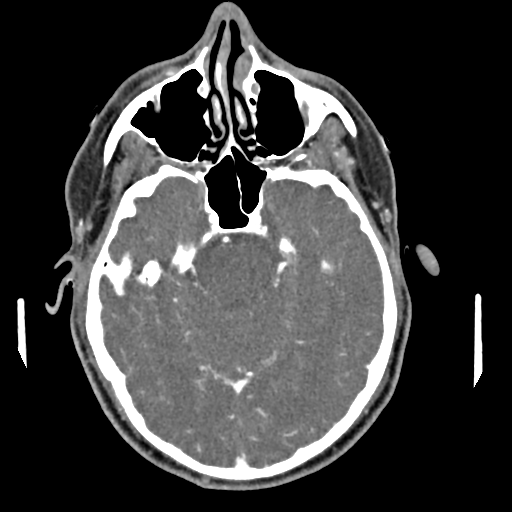 Cerebellar infarct due to vertebral artery dissection with posterior fossa decompression (Radiopaedia 82779-97029 C 2).png