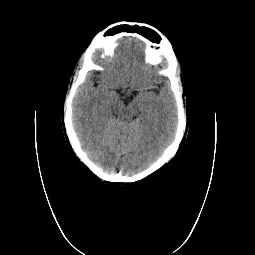 File:Cerebellar infarct due to vertebral artery dissection with posterior fossa decompression (Radiopaedia 82779-97030 Coronal non-contrast 1).png