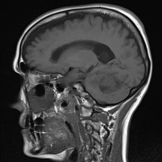 File:Cerebellar metastases (Radiopaedia 24038-24249 Sagittal T1 11).jpg