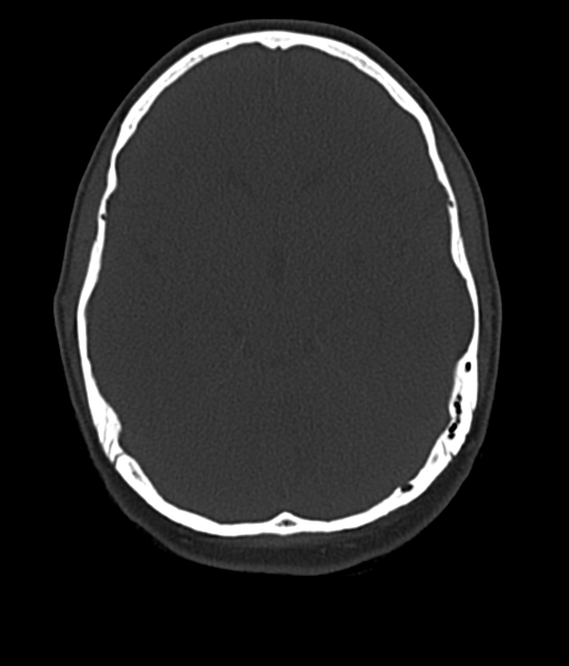 File:Cerebellar metastases - colorectal adenocarcinoma (Radiopaedia 40947-43652 AX Bone C- 2.0 MPR 24).png