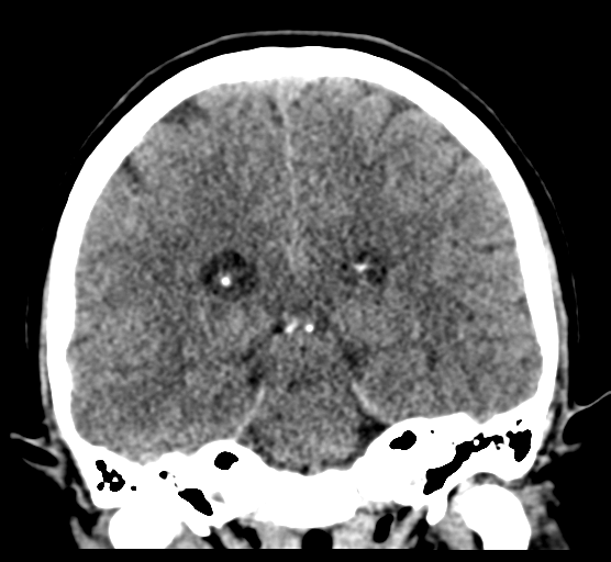 Cerebellar metastases - colorectal adenocarcinoma (Radiopaedia 40947-43652 Coronal non-contrast 57).png